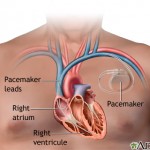 pacemaker_nlm_nih_gov